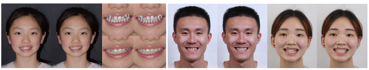 iOrthoPredictor: Model-guided Deep Prediction of Teeth Alignment