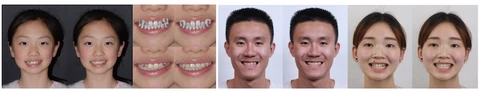 iOrthoPredictor: Model-guided Deep Prediction of Teeth Alignment — research thumbnail
